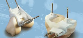 Custom Made Patient Specific Cutting Blocks/ Jigs
