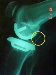 Complication: X-Ray demonstrating a dislocated meniscal bearing in a uni-compartmental knee replacement