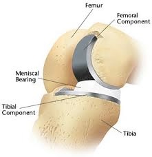 Labelled diagram of uni knee replacement