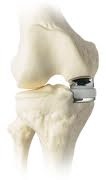 Model of partial knee replacement