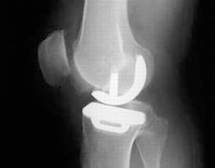 X-Ray showing Oxford Partial Knee Replacement