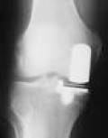 X-Ray of a medial Oxford Uni-compartmental Knee Replacement